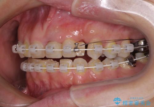 歯が全く咬みあわない 矯正と補綴の全顎治療の治療中