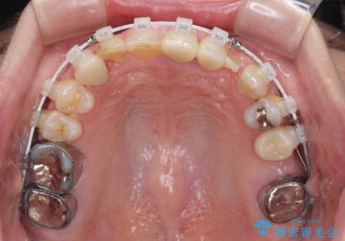 歯が全く咬みあわない　矯正と補綴の全顎治療の治療中