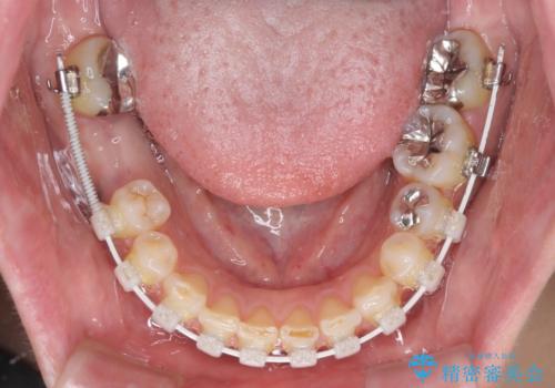 歯が全く咬みあわない 矯正と補綴の全顎治療の治療中