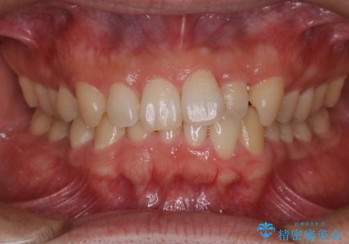 内側に入っていた前歯とガタつきをインビザラインで綺麗に並べるの症例 治療前