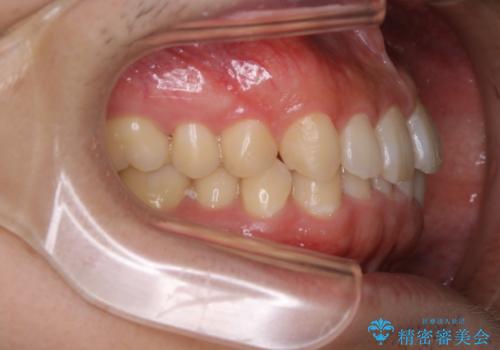 内側に入っていた前歯とガタつきをインビザラインで綺麗に並べるの治療前