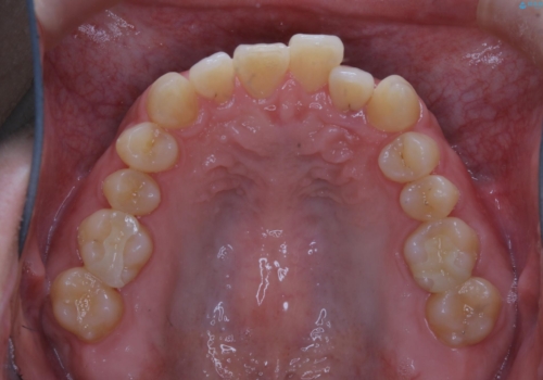 内側に入っていた前歯とガタつきをインビザラインで綺麗に並べるの治療前
