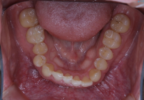 内側に入っていた前歯とガタつきをインビザラインで綺麗に並べるの治療前