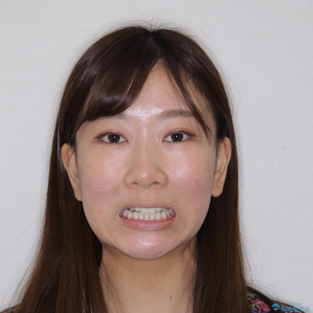 【モニター】前歯の変色とデコボコを改善 インビザラインとオールセラミックの治療後(顔貌)