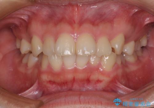 【モニター】治療途中で引っ越し ワイヤー装置を用いた抜歯矯正の治療前