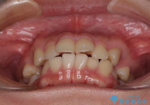 【モニター】治療途中で引っ越し ワイヤー装置を用いた抜歯矯正の治療前