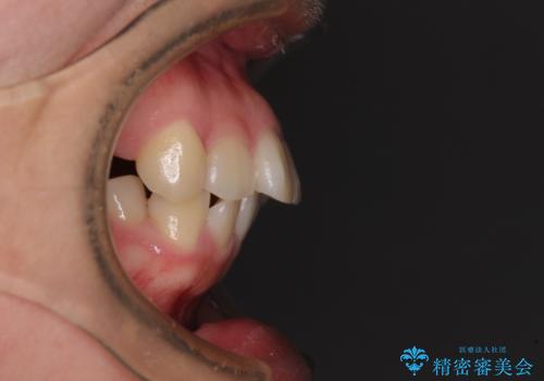 【モニター】治療途中で引っ越し ワイヤー装置を用いた抜歯矯正の治療前