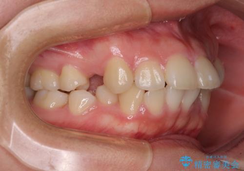 【モニター】治療途中で引っ越し ワイヤー装置を用いた抜歯矯正の治療前