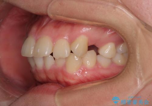 【モニター】治療途中で引っ越し ワイヤー装置を用いた抜歯矯正の治療前