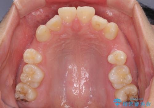 【モニター】治療途中で引っ越し ワイヤー装置を用いた抜歯矯正の治療前