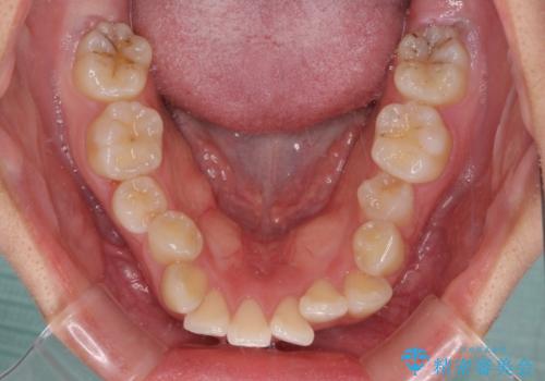 【モニター】治療途中で引っ越し ワイヤー装置を用いた抜歯矯正の治療前