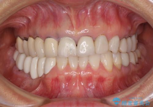 以前治療した歯がボロボロに　全顎補綴治療の症例 治療前