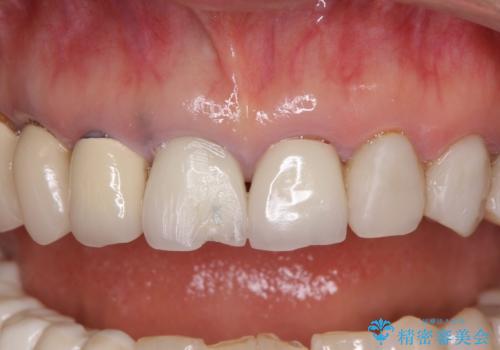 以前治療した歯がボロボロに　全顎補綴治療の治療前