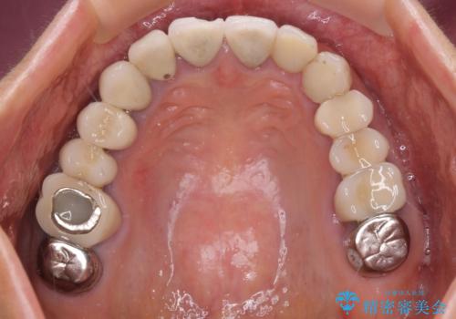 以前治療した歯がボロボロに　全顎補綴治療の治療前
