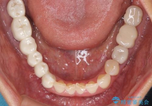 以前治療した歯がボロボロに 全顎補綴治療の治療前