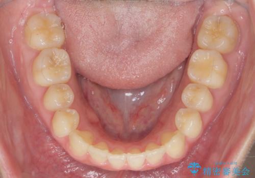 [ マウスピース矯正 ]  とび出ている前歯を治したいの治療後