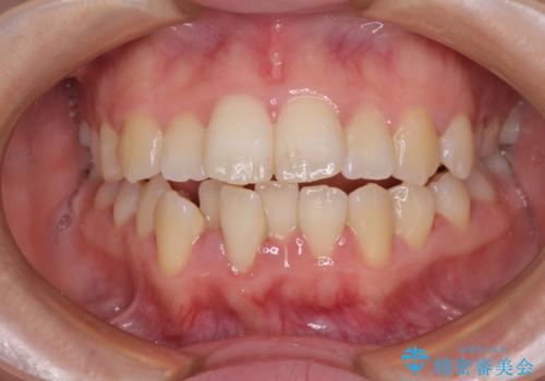 上下非接触で突出した前歯　ワイヤー装置による抜歯矯正の症例 治療前