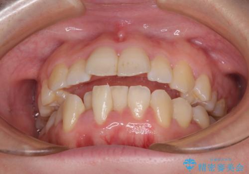 上下非接触で突出した前歯 ワイヤー装置による抜歯矯正の治療前