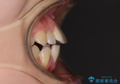 上下非接触で突出した前歯 ワイヤー装置による抜歯矯正の治療前