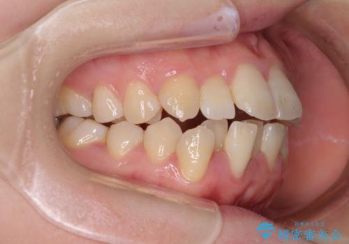 上下非接触で突出した前歯 ワイヤー装置による抜歯矯正の治療前