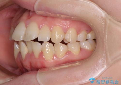 上下非接触で突出した前歯 ワイヤー装置による抜歯矯正の治療前