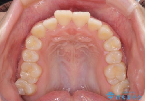 上下非接触で突出した前歯 ワイヤー装置による抜歯矯正の治療前