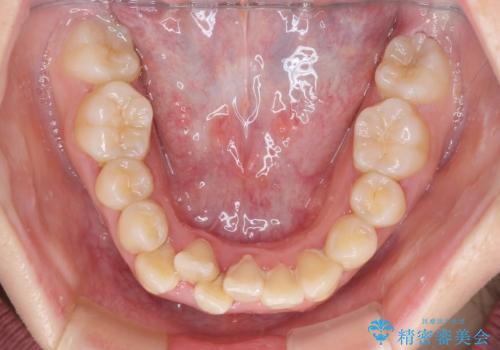 上下非接触で突出した前歯　ワイヤー装置による抜歯矯正の治療前