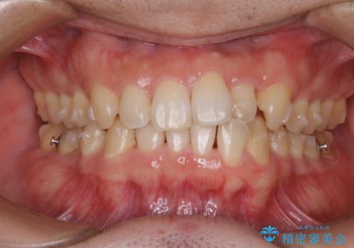 内側に入っていた前歯とガタつきをインビザラインで綺麗に並べるの治療中