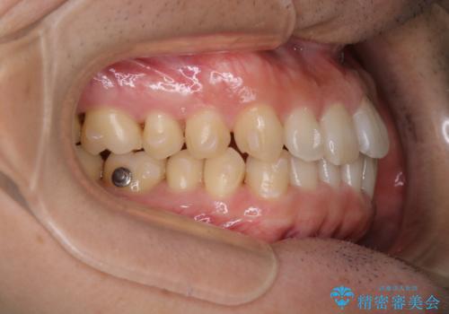 内側に入っていた前歯とガタつきをインビザラインで綺麗に並べるの治療中