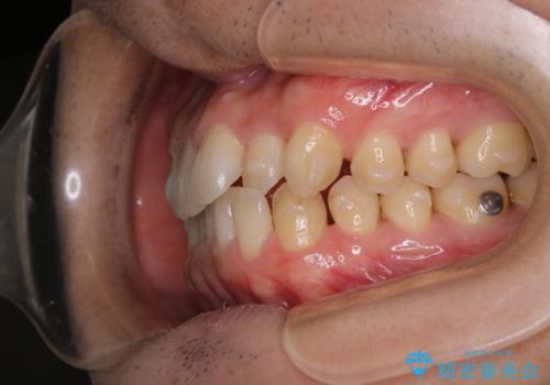 内側に入っていた前歯とガタつきをインビザラインで綺麗に並べるの治療中