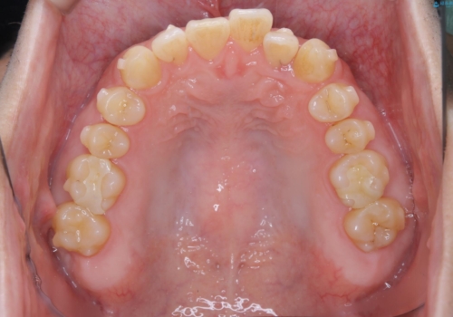 内側に入っていた前歯とガタつきをインビザラインで綺麗に並べるの治療中