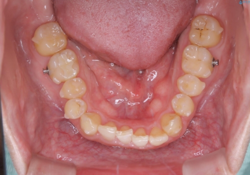 内側に入っていた前歯とガタつきをインビザラインで綺麗に並べるの治療中