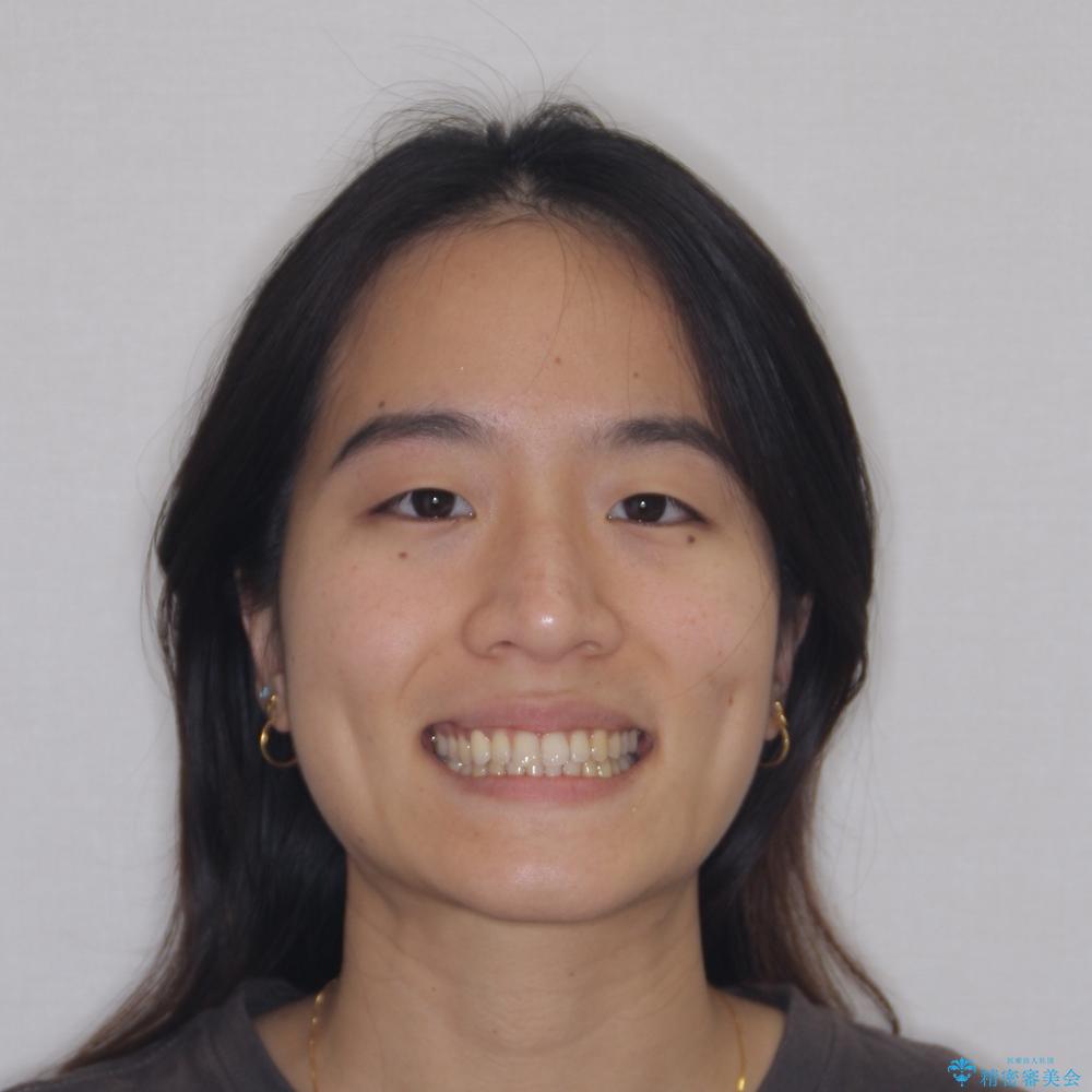 【モニター】下顎の気になる八重歯を改善 インビザラインによる矯正治療の治療後(顔貌)