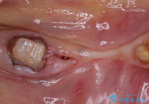 以前治療した歯がボロボロに 全顎補綴治療の治療前