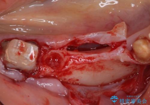 以前治療した歯がボロボロに 全顎補綴治療の治療中