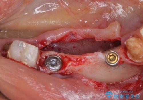 以前治療した歯がボロボロに 全顎補綴治療の治療前