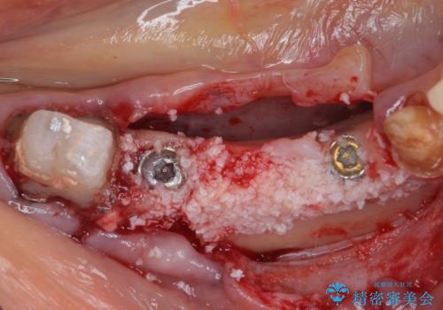 以前治療した歯がボロボロに 全顎補綴治療の治療中