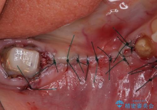 以前治療した歯がボロボロに 全顎補綴治療の治療後