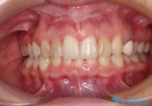 【モニター】前歯の変色とデコボコを改善 インビザラインとオールセラミックの治療中