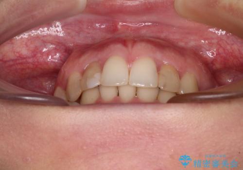 【モニター】前歯の変色とデコボコを改善 インビザラインとオールセラミックの治療中