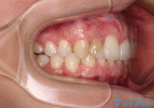 【モニター】前歯の変色とデコボコを改善 インビザラインとオールセラミックの治療中