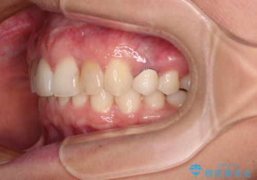 【モニター】前歯の変色とデコボコを改善 インビザラインとオールセラミックの治療中