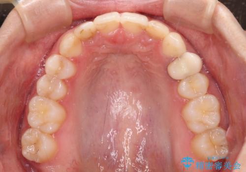 【モニター】前歯の変色とデコボコを改善 インビザラインとオールセラミックの治療中