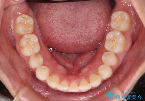 【モニター】前歯の変色とデコボコを改善 インビザラインとオールセラミックの治療中
