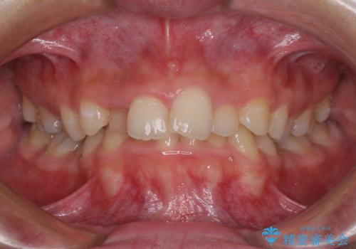 【モニター】前歯のデコボコと変色した前歯をインビザラインとオールセラミッククラウンでの症例 治療前