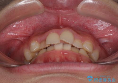 【モニター】前歯のデコボコと変色した前歯をインビザラインとオールセラミッククラウンでの治療前