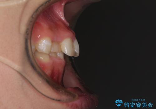 【モニター】前歯のデコボコと変色した前歯をインビザラインとオールセラミッククラウンでの治療前