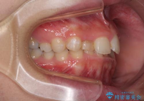 【モニター】前歯のデコボコと変色した前歯をインビザラインとオールセラミッククラウンでの治療前