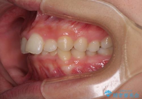 【モニター】前歯のデコボコと変色した前歯をインビザラインとオールセラミッククラウンでの治療前