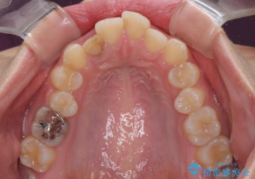 【モニター】前歯のデコボコと変色した前歯をインビザラインとオールセラミッククラウンでの治療前